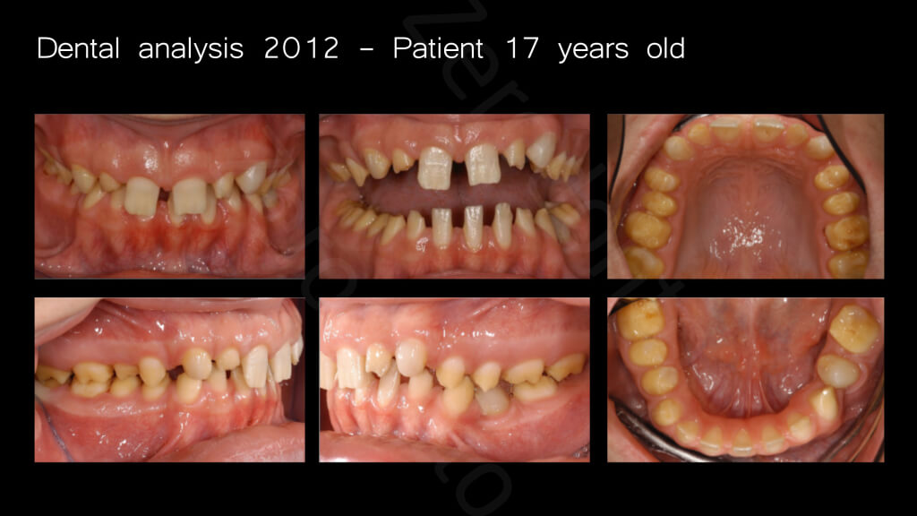 007_dental analysis_2012_17years