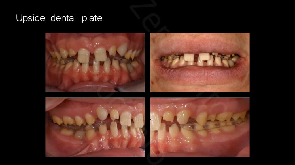 009_upside_dental_plate