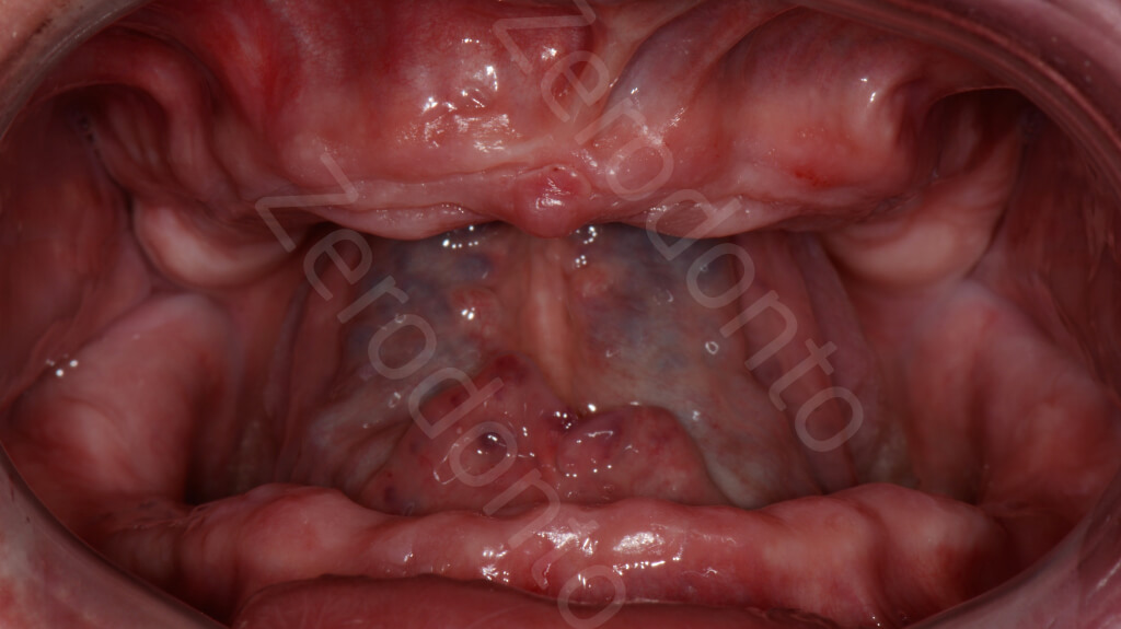 1.Complete edentulous arches