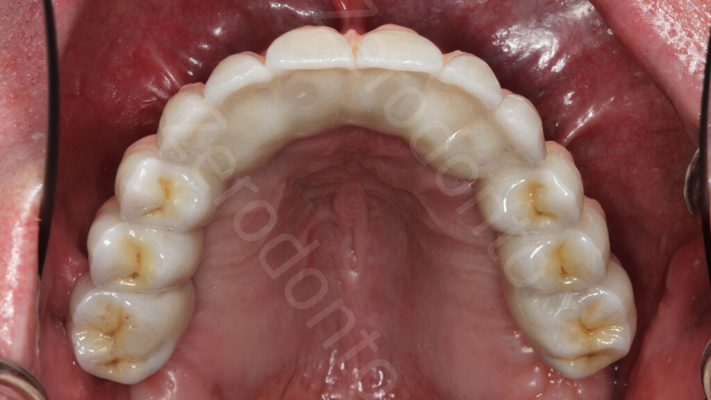 22. Max occlusion