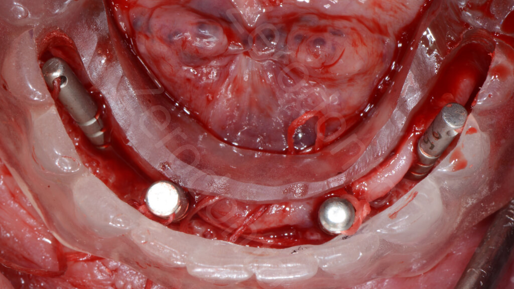 4. mandibular surgery