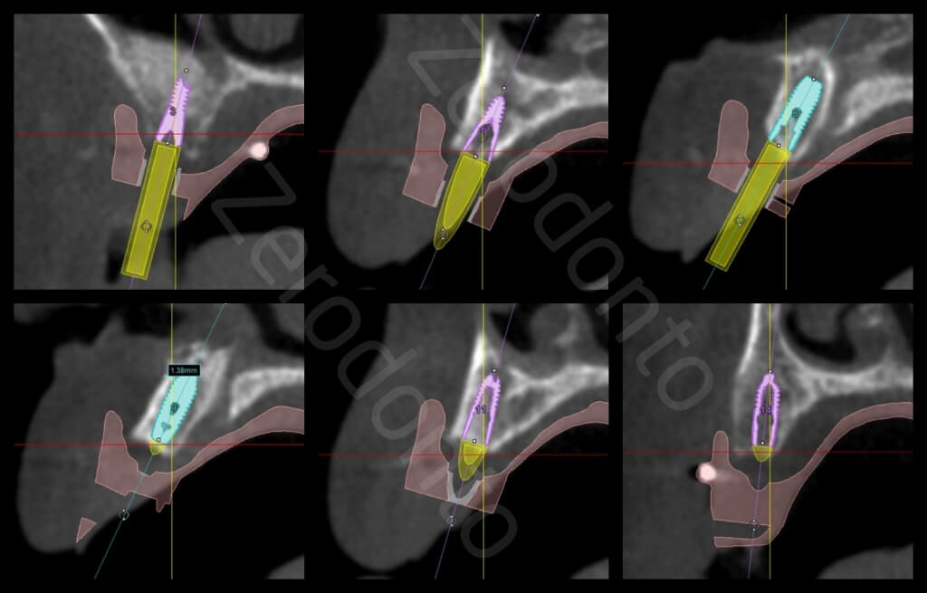 5. CADCAM guide 1