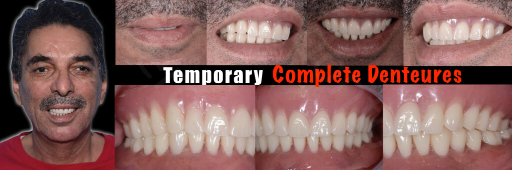 Implant retained Overdentures.004