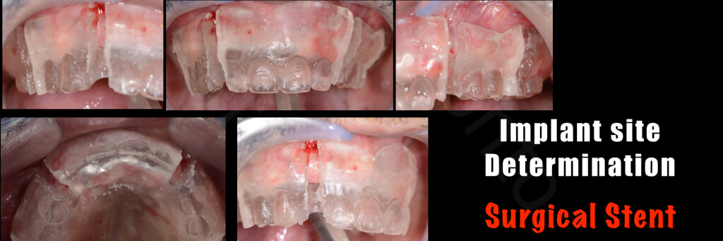 Implant retained Overdentures.007