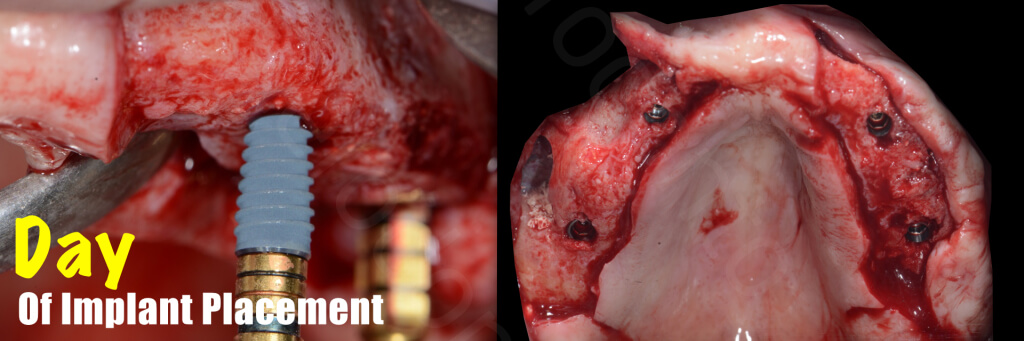 Implant retained Overdentures.011