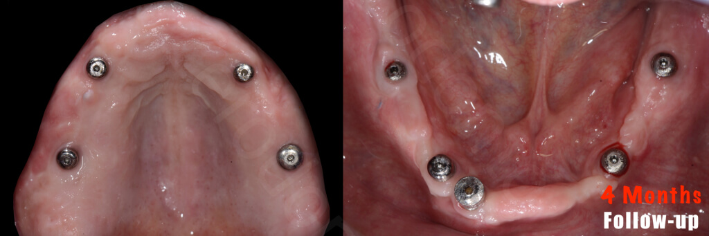 Implant retained Overdentures.014