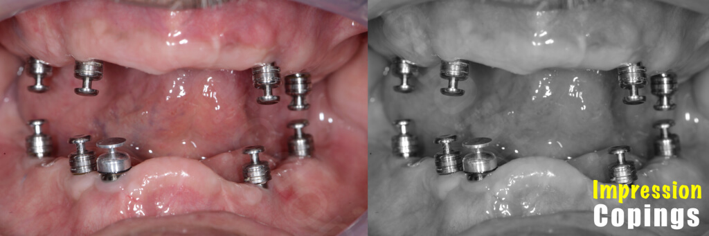 Implant retained Overdentures.017