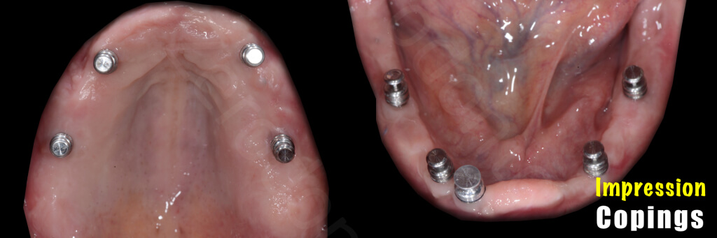 Implant retained Overdentures.018