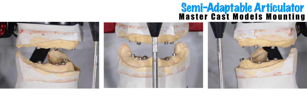 Implant retained Overdentures.025