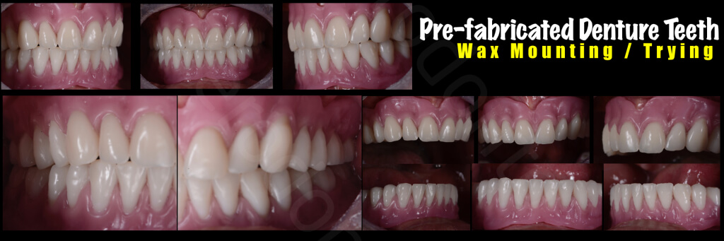 Implant retained Overdentures.030