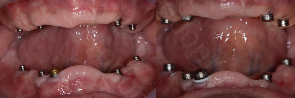 Implant retained Overdentures.034