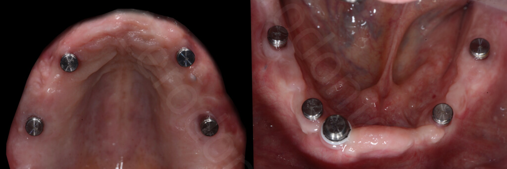 Implant retained Overdentures.035