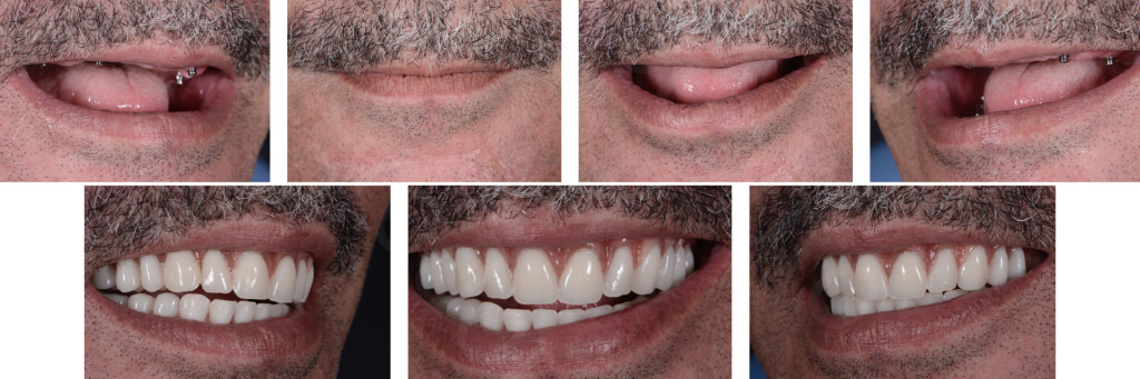 Implant retained Overdentures.037