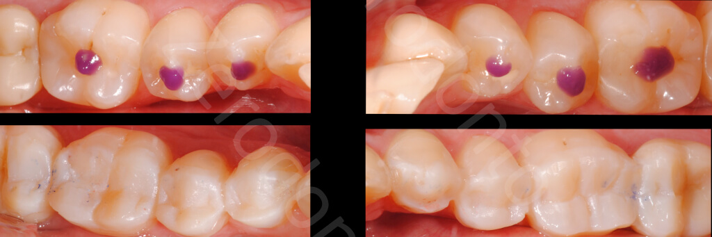 ZERODONTO GOR 3 STEP 40.015