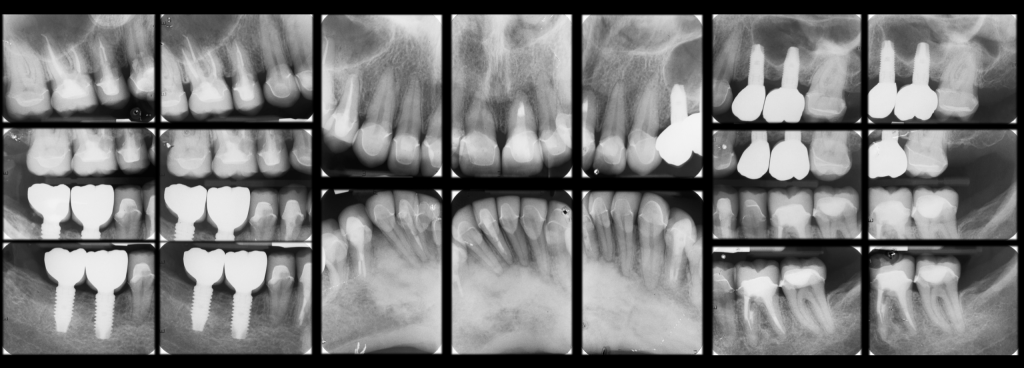 xray after