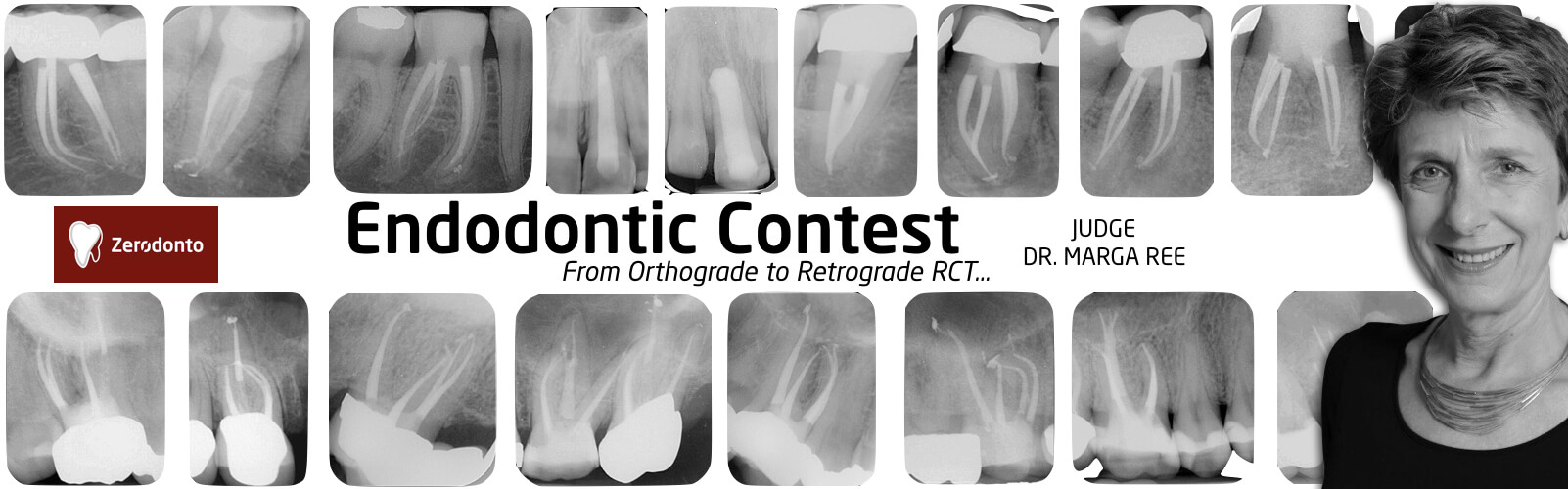 Endodontic Contest - from Retrograde to Orthograde RCT - contest #5, marga ree