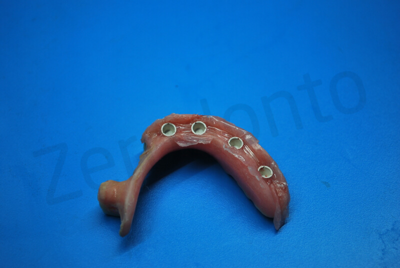 11-conversion of old denture to hybrid