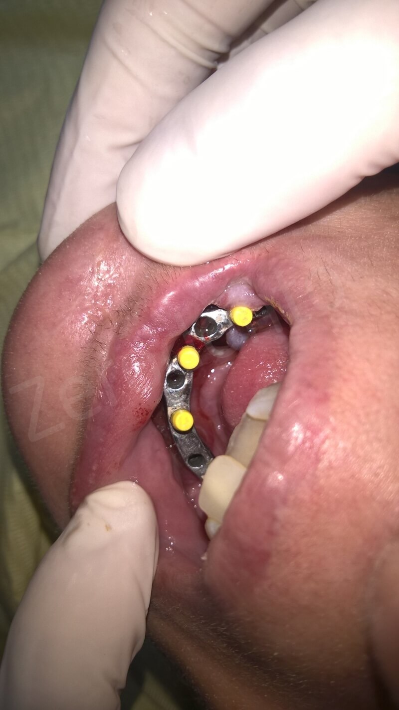 15 Intra oral view of the bar