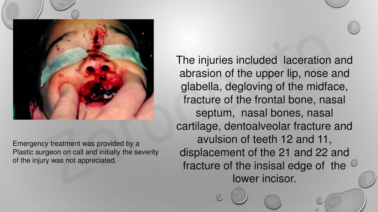 Niel Grundling Rehabilitation of a midface injury (2)-04