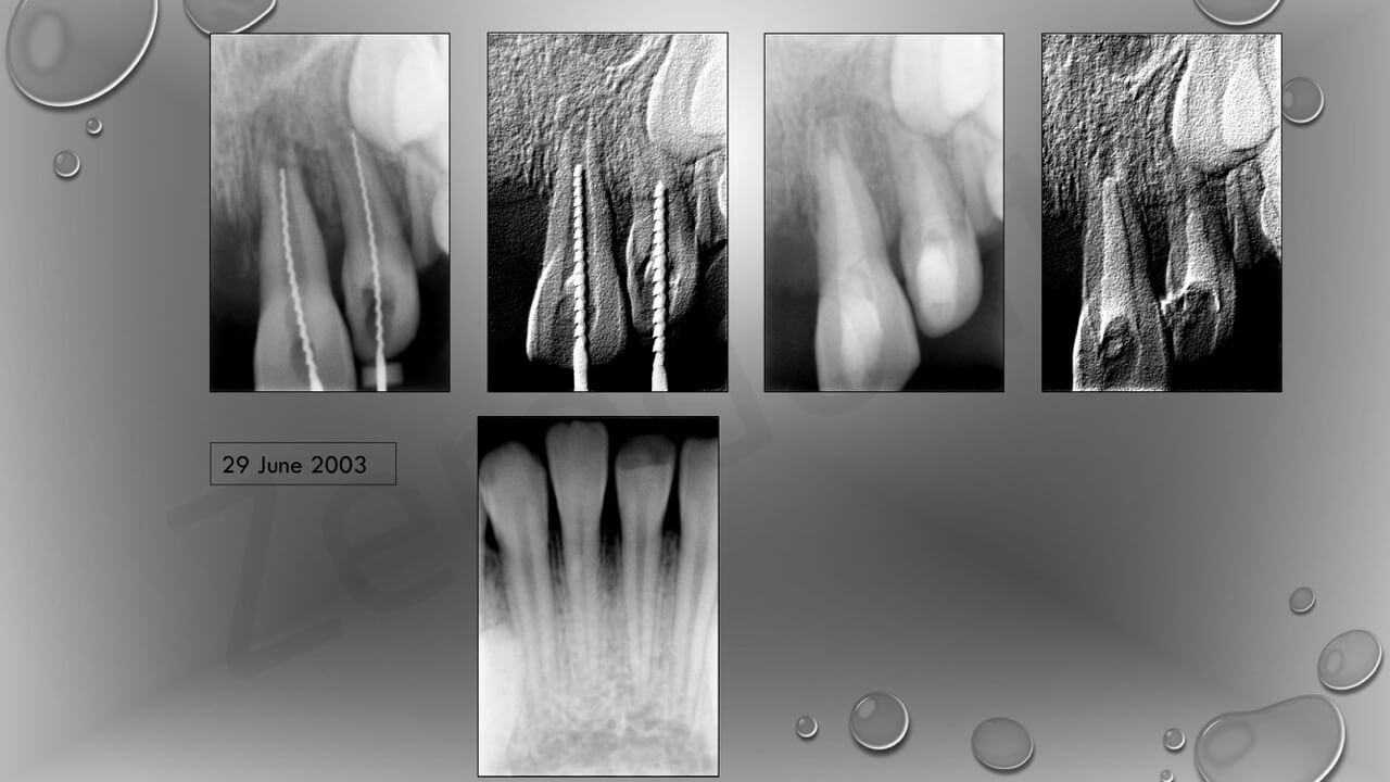 Niel Grundling Rehabilitation of a midface injury (2)-08