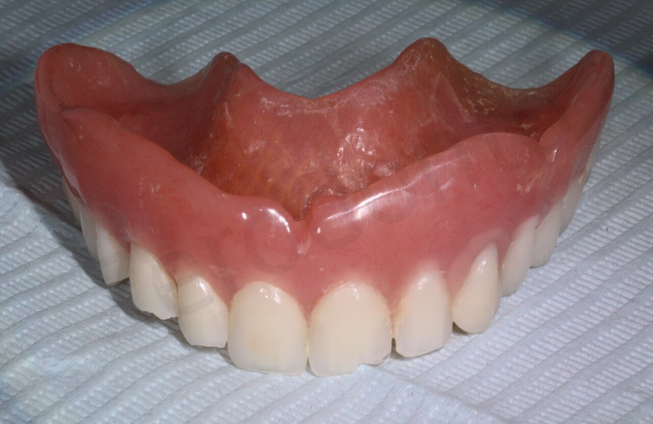 Prior Full Overdenture Front View