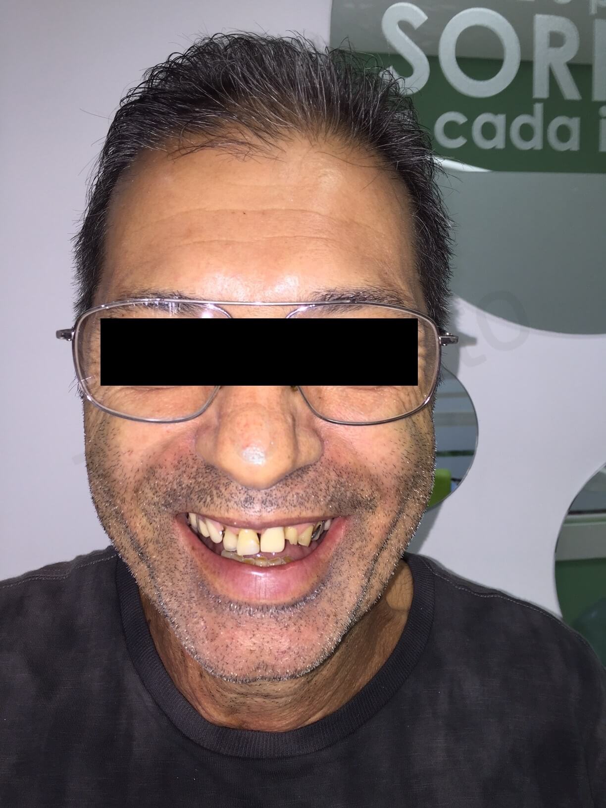 initial case with removable partial denture BIG SMILE