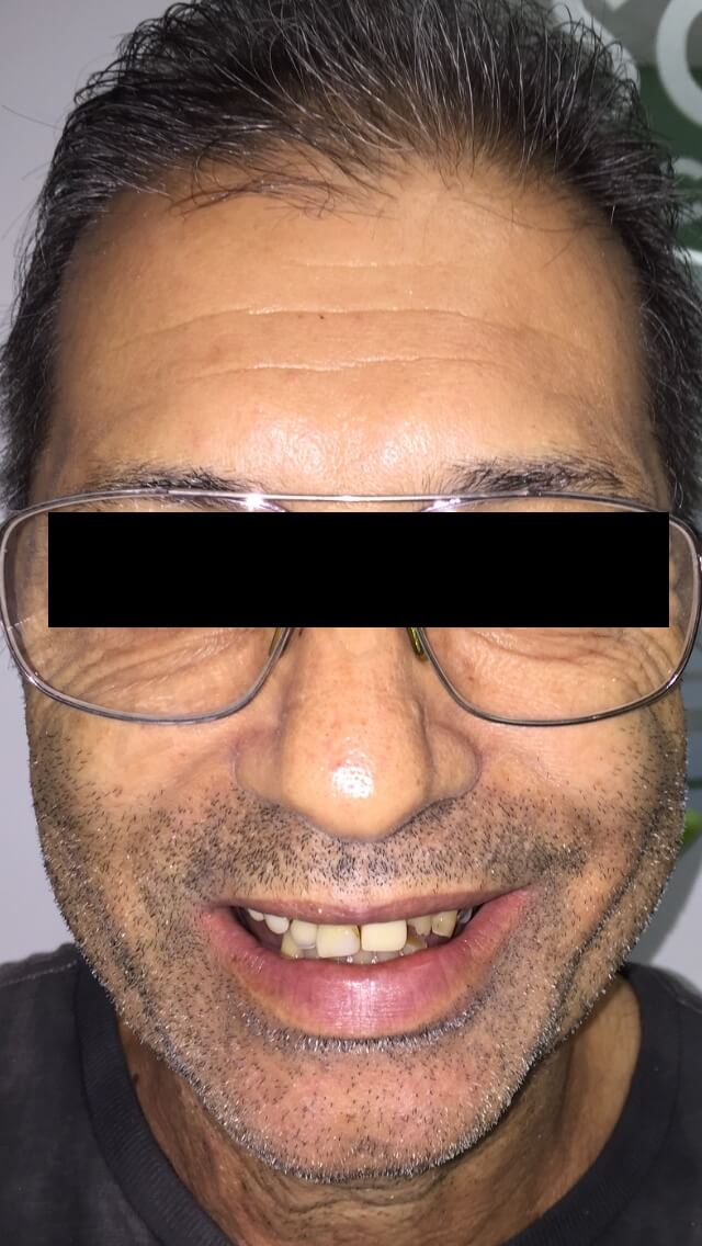 initial case with removable partial denture NORMAL SMILE