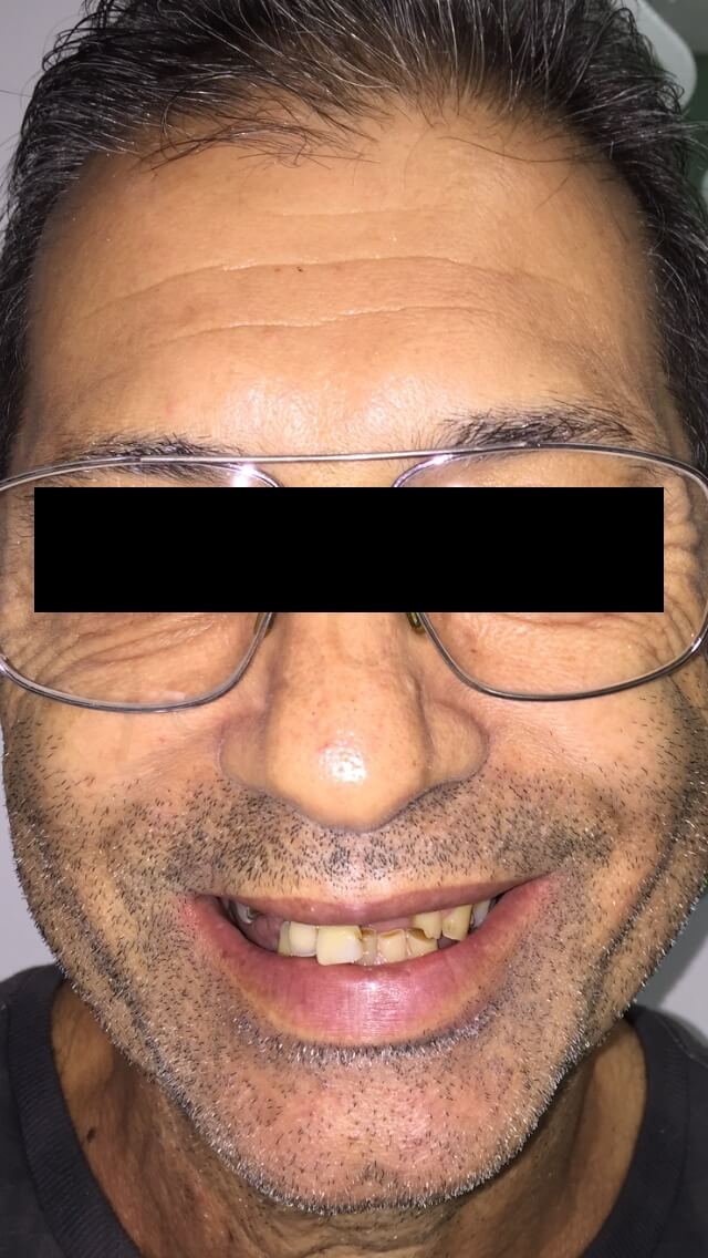 initial case without removable partial denture