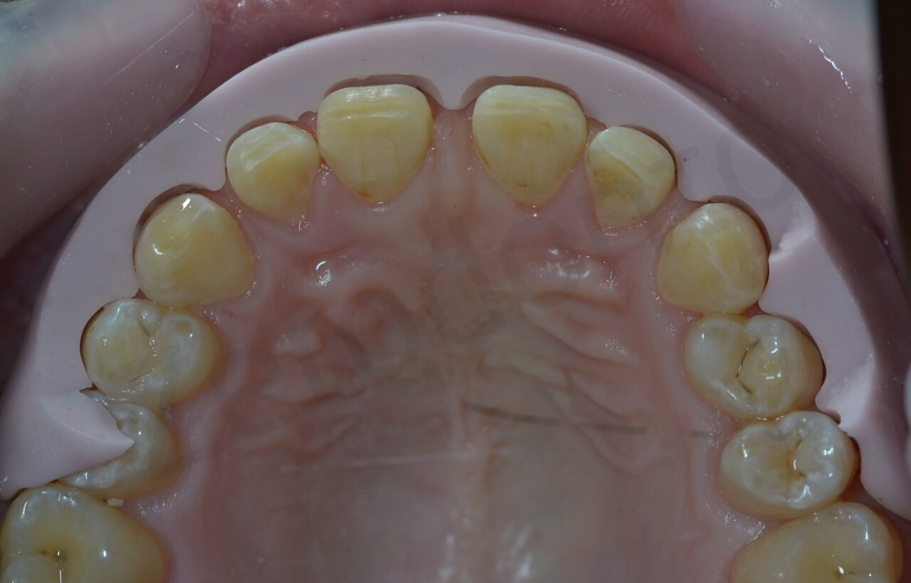 5.5 Preparation guide occlusal