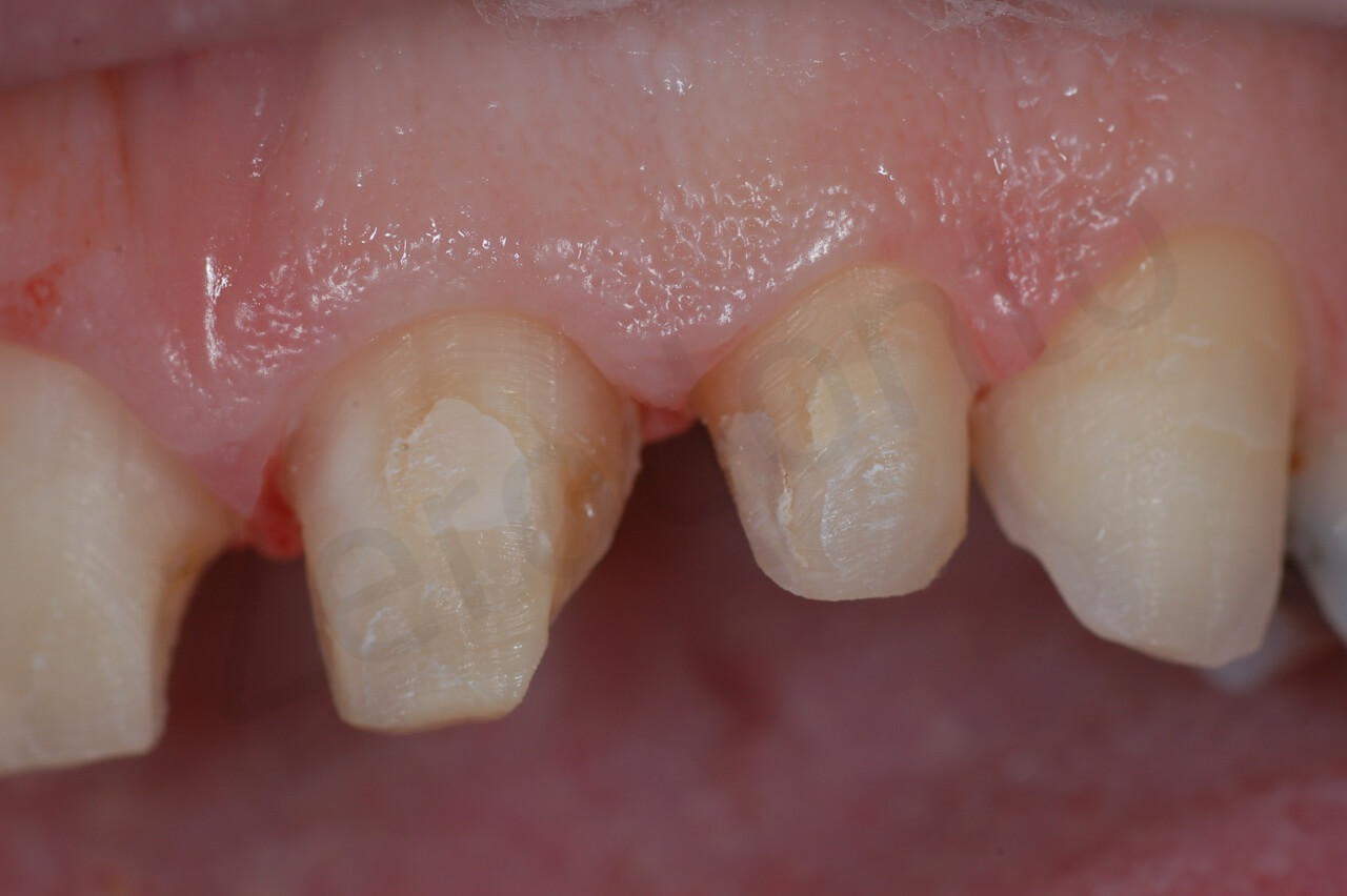 Teeth preparation (zoom intra-oral left side)