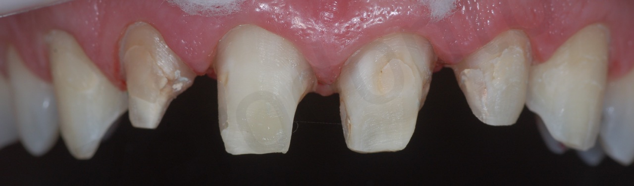 teeth preparation (detail intra-oral, with black contrast)
