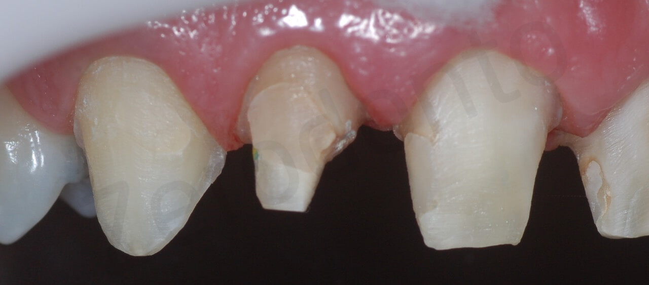 teeth preparation (detail right side intra-oral with black contrast)