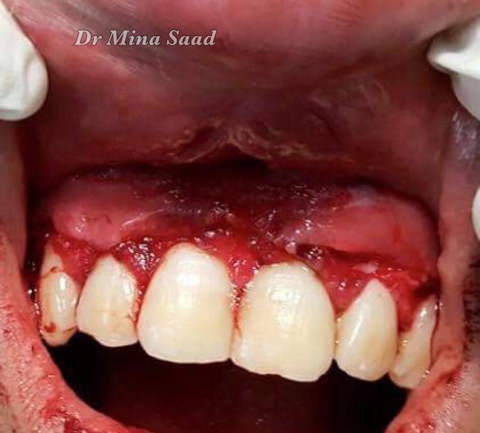 excision of the pseudo gingiva