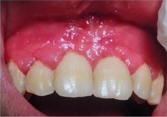 after double gingiva