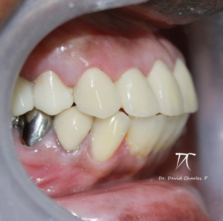 Prosthetic Management Of Failed Maxillary Pfm Crowns David Charles Prosthocontest